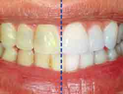 خمیردندان باعث از بین رفتن جرم دندان نمیشود !